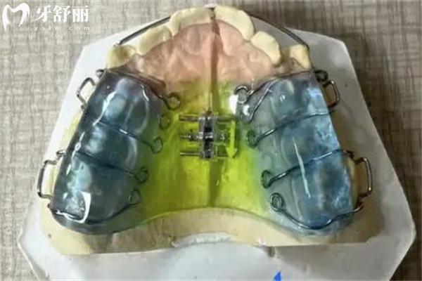 兒童矯治器有哪些品牌比較好用?2025兒童牙齒矯正器品牌選擇指南收好