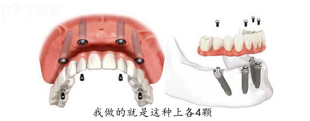 杭州蕭山牙科醫(yī)院收費(fèi)標(biāo)準(zhǔn)調(diào)整(種植牙