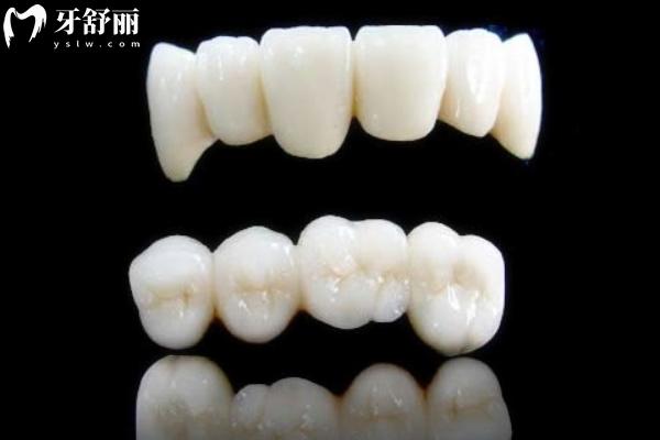 如何辨別威蘭德全瓷牙真假