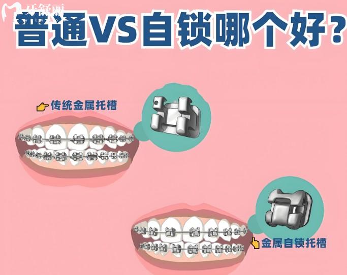 自鎖VS非自鎖托槽哪個(gè)好