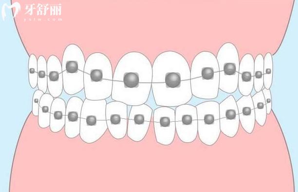 自鎖托槽與非自鎖托槽的區(qū)別