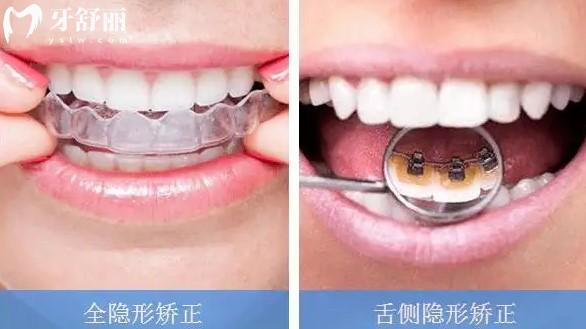 蘭州諾貝爾口腔醫(yī)院隱形正畸怎么樣