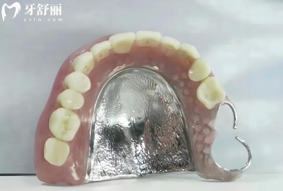 純鈦支架活動(dòng)義齒多少錢(qián)