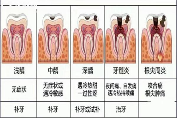 齲齒一度到五度圖片照片