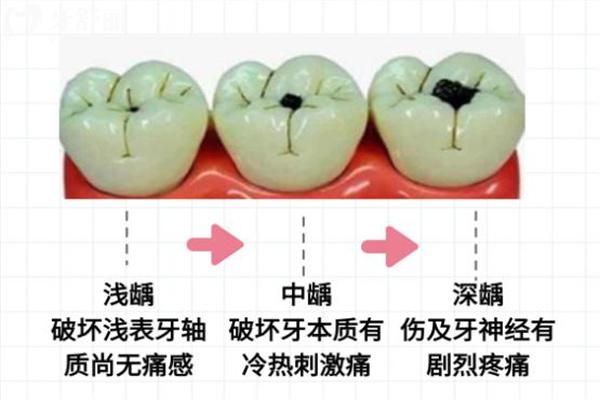 齲齒一度到五度圖片照片