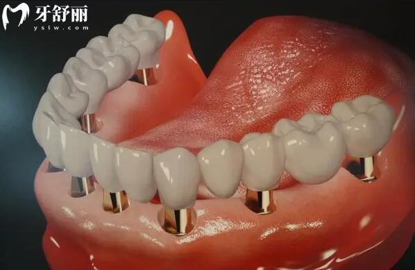 2025佛山禪醫(yī)口腔醫(yī)院收費(fèi)標(biāo)準(zhǔn)明細(xì):種植牙790+兒童矯正3880+全瓷牙1300+