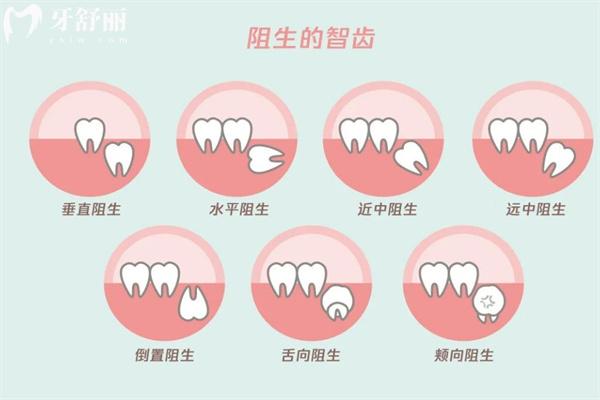 不同類型智齒圖片大全