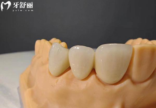 義佳微納熔覆義齒是什么材料