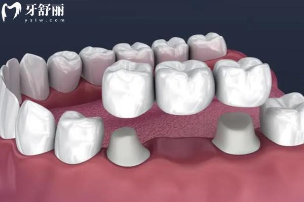 義佳微納熔覆義齒是什么材料
