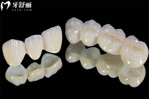 一顆牙齒牙套多少錢 三大牙冠種類及價格表顯示金屬牙500+陶瓷牙800+全瓷牙1200+