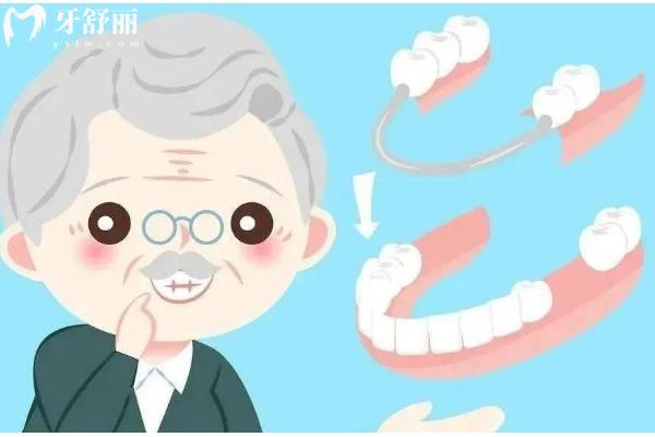 活動義齒的種類和材料有哪些？種類與材料的口腔修復新手指南