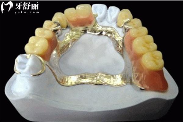 無掛鉤活動假牙怎么鑲2.jpg