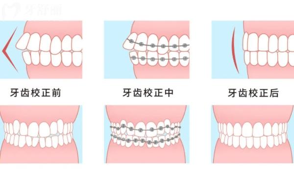 北京舌側(cè)矯正哪個(gè)醫(yī)生好？