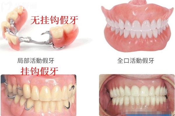 裝半口假牙有幾種方法?活動牙/固定牙究竟哪種好對比材料及價格表來看看吧