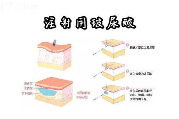 韓國(guó)打玻尿酸多少錢一支