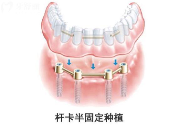 海南種植牙價格表在線查詢
