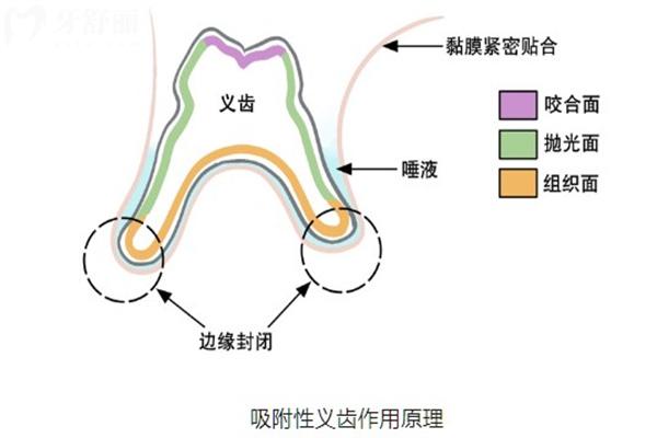 北京吸附性義齒哪家醫(yī)院可做?對比價格費用/技師水平/患者口碑這幾家可選