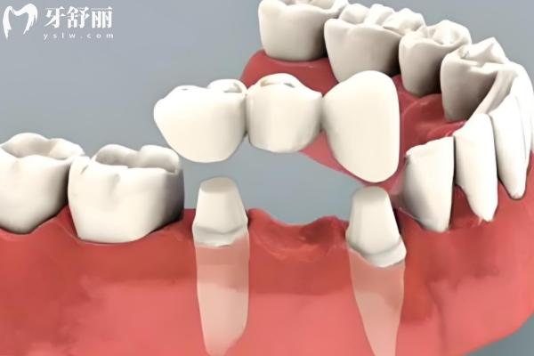 深圳活動假牙的種類及價格