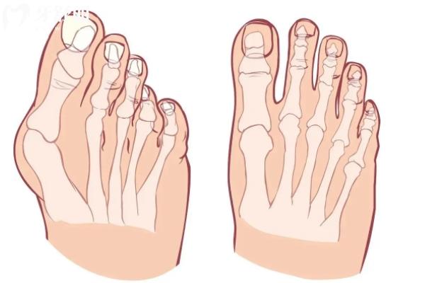 重慶騎士醫(yī)院大腳骨科怎么樣？