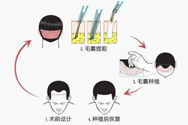 大麥植發(fā)在國內(nèi)有多少家門店