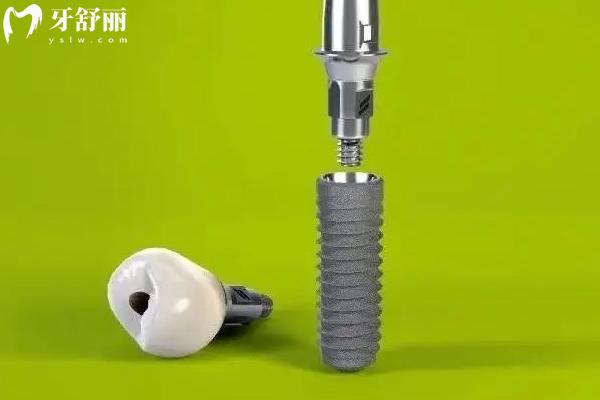 ITI種植體三種型號(hào)怎么選？