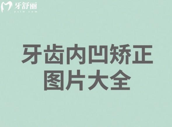 牙齒內(nèi)凹矯正圖片大全