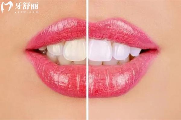 玻璃瓷和水晶瓷貼面哪個(gè)好