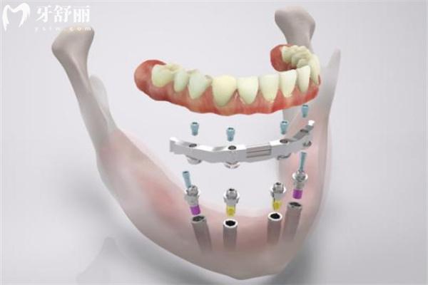 國內(nèi)正規(guī)牙科收費(fèi)價(jià)目表:含種植牙/牙齒矯正/補(bǔ)牙修復(fù)/牙周治療/美白等價(jià)格一覽