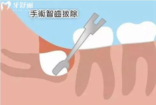 杭州拔智齒收費價目表