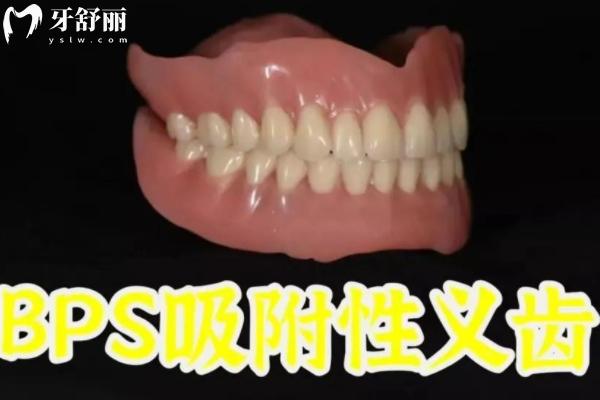 bps吸附性義齒5大優(yōu)缺點(diǎn)