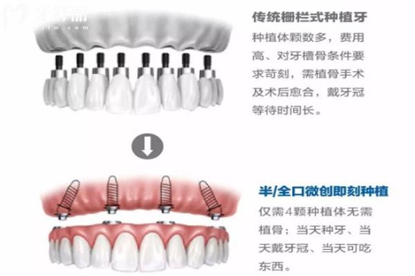 滿口種植牙大概多少錢?查詢老人全口假牙價目表可知3-20w不等可選活動假牙