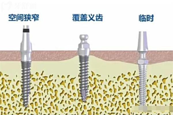 奧齒泰種植體型號和規(guī)格表大全:四大系列滿足不同患者種植需求