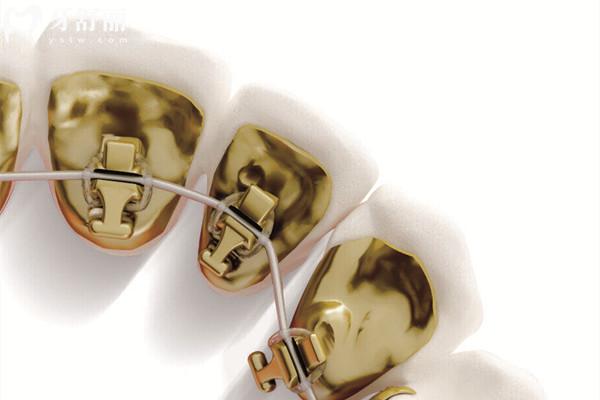 國(guó)產(chǎn)eBrace舌側(cè)牙套