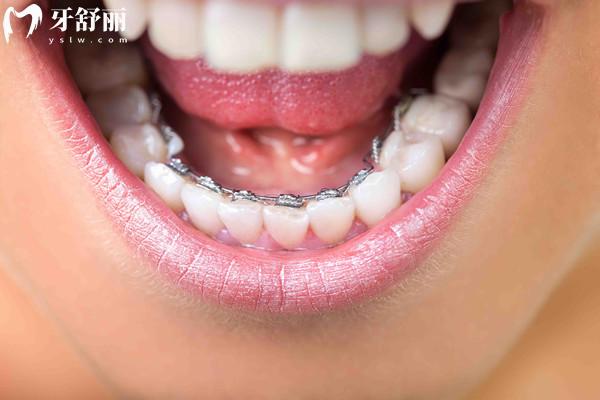 國(guó)產(chǎn)eBrace舌側(cè)牙套