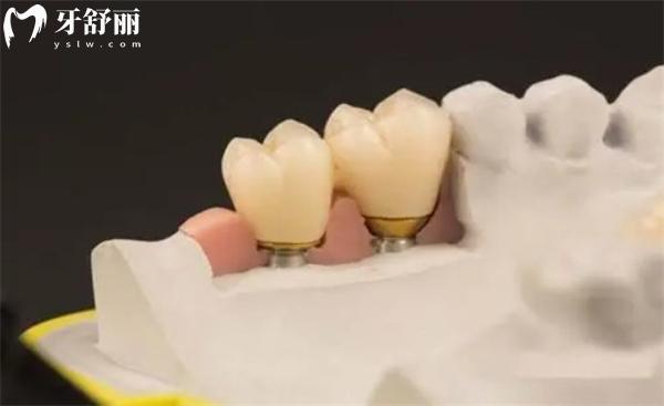 吸附性義齒真的那么好嗎?和種植牙對比哪個好?分析優(yōu)缺點及價格表