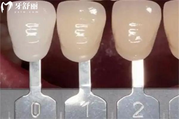 牙冠戴久了里面真牙會壞嗎?盤點牙冠一般壽命是多久及牙冠更換周期建議