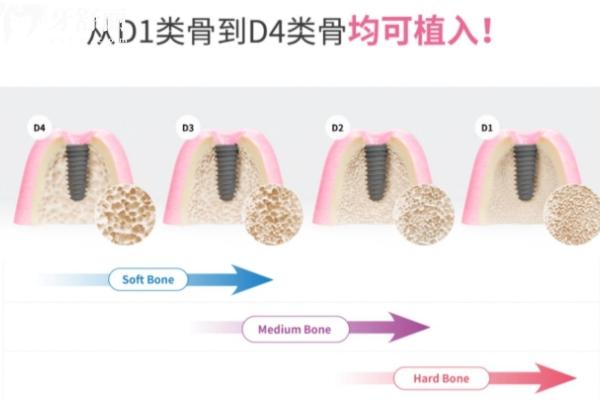 Dio種植體不是雜牌