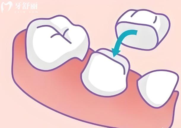 成都烤瓷牙多少錢一顆價格表2025:(收費500-4000元起)材質(zhì)品牌決定費用