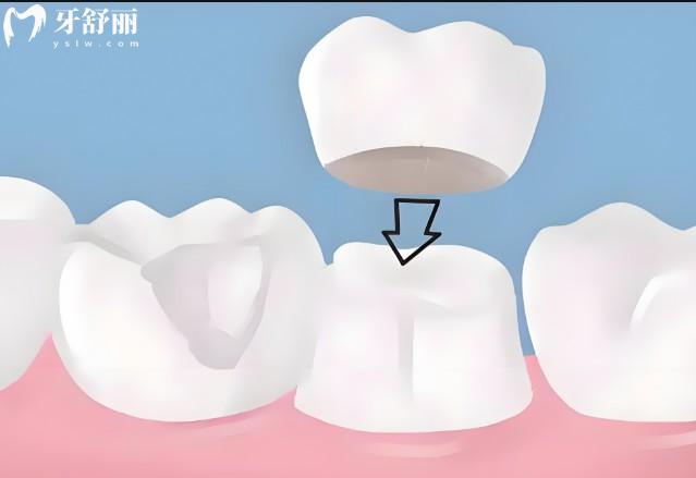 成都烤瓷牙多少錢一顆價格表2025:(收費500-4000元起)材質(zhì)品牌決定費用
