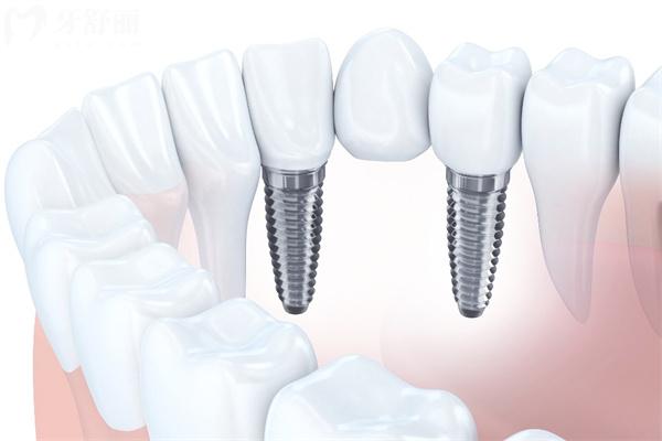 2025種植牙多少錢一顆價格表公開:韓系植體1600+美系植體3500+德系植體4200+瑞士植體4800+