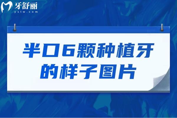 半口6顆種植牙的樣子圖片分享!對比半口4顆種植牙更加穩(wěn)固優(yōu)勢滿滿