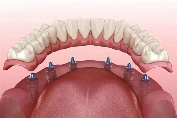 半口6顆種植牙圖片大全