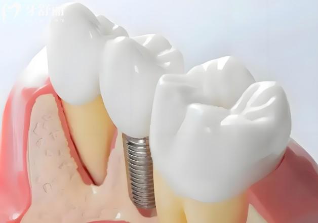 意大利種植體哪個牌子好?排名前五的BB/西泰克/西傲/易植/比多亞都不錯