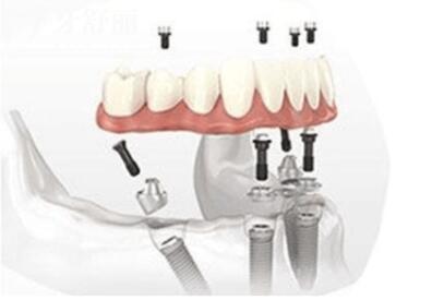 2025海絲口腔收費(fèi)明細(xì)表(全新價(jià)格不貴)種牙1680+