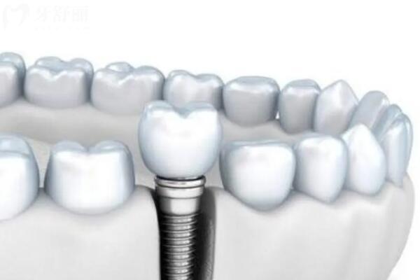 西寧新橋口腔醫(yī)院2025收費(fèi)標(biāo)準(zhǔn):種植牙