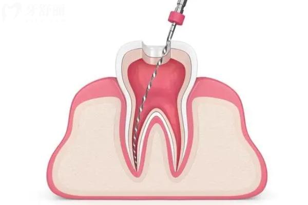 玉林牙齒根管治療多少錢