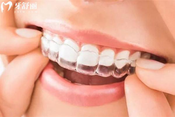 為什么正畸醫(yī)生都推薦隱適美