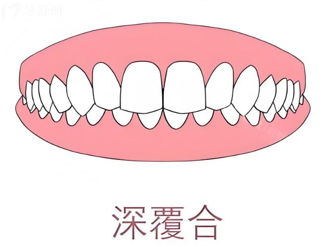 為什么深覆合不能種植門牙