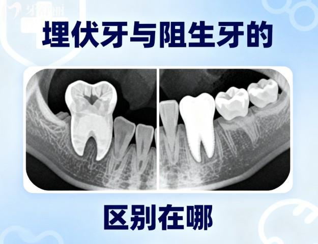 埋伏牙與阻生牙的區(qū)別在哪?還有相對(duì)應(yīng)的治療方案及術(shù)后注意事項(xiàng)分享