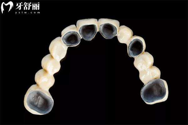 哪種假牙便宜又耐用?常見3種不同假牙的分類及特點一覽便知